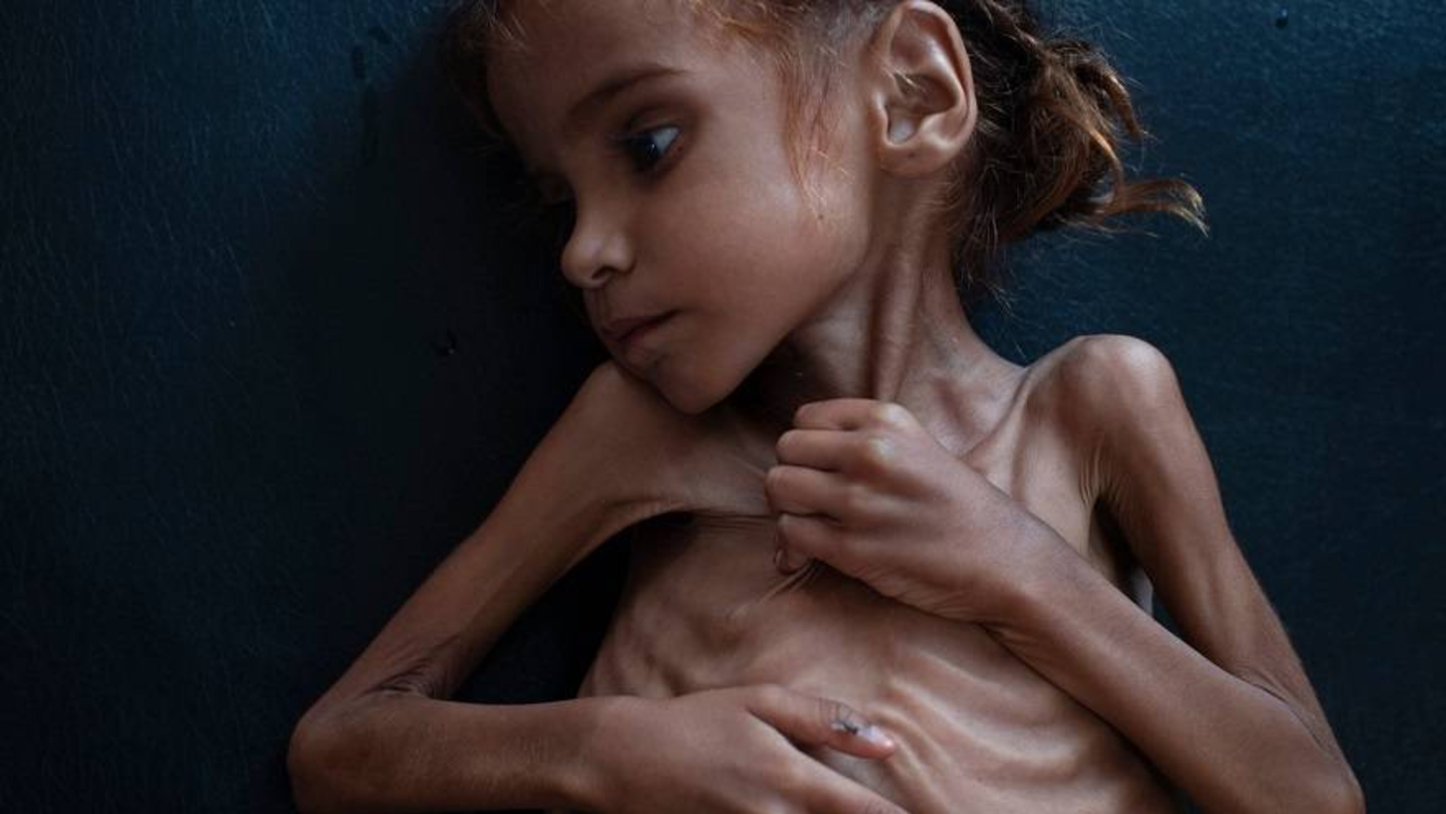 Karman in an article in Time magazine: Amal’s image summarizes the humanitarian situation in Yemen